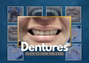 A Simple Partial Denture Case and a Satisfied Patient